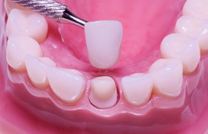 Dental-Crowns