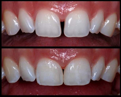 Diastema-Closure