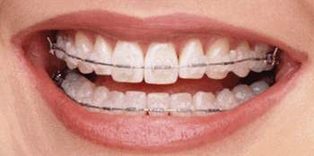 braces-invisible-braces