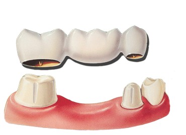 dental-bridge-diag