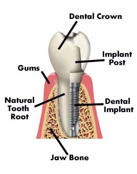 dental-implants12