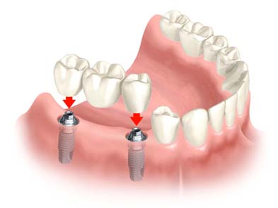 dental-implants1234