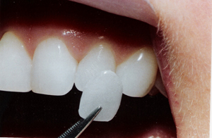 dental_veneer