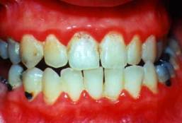 gum-disease1
