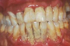 gum-disease2