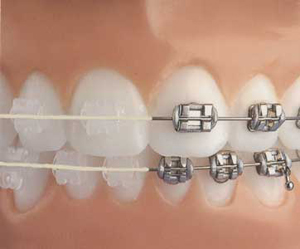 invisible-clear-braces