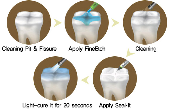 pit-and-fissure-sealants