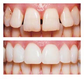 veneers-before-after